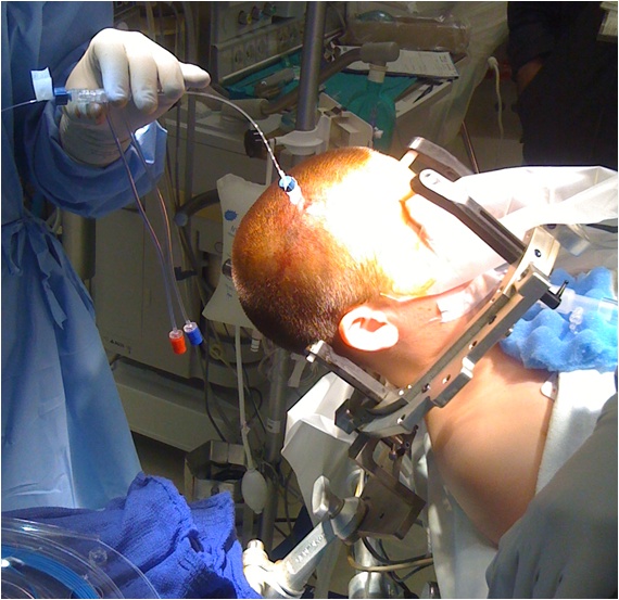 Stereotactic laser surgery