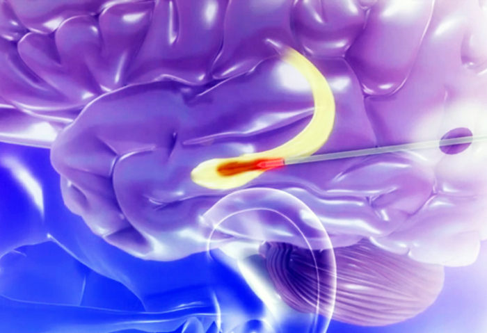 Minimally invasive laser-based surgery offers a quicker recuperation time for epilepsy patients.