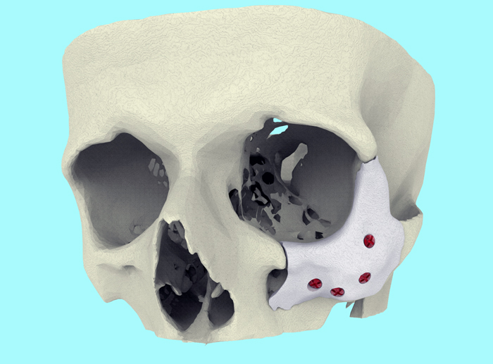 Xilloc's CT-Bone is described as 