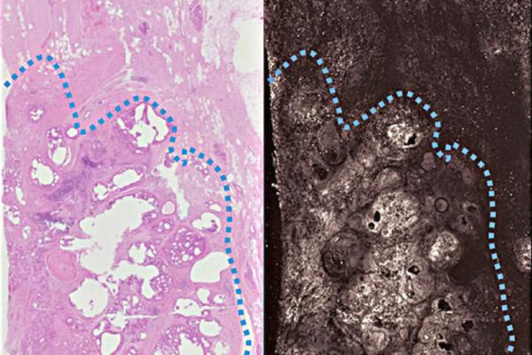 Margin call: revealing tumor boundaries