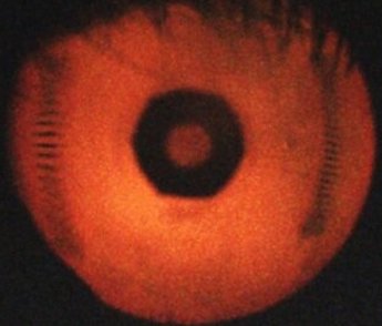 Eyes have it: tear film imaging