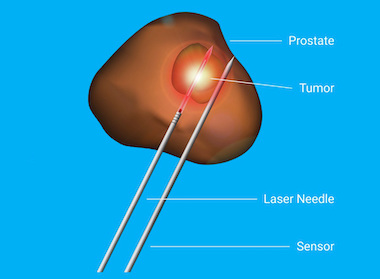 Focused therapy: laser ablation of prostate tumor