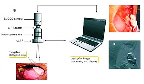 Non-invasive spectral imaging system enables mass screening for oral cancers.