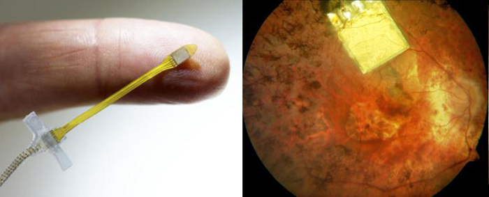Retina Implant's microchip is implanted below the retina, in the macular region where light-sensitive photoreceptor cells are located. 