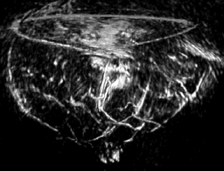 Optoacoustic imaging of breast cancer