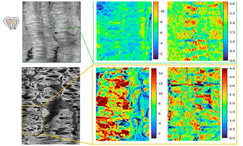 Quick optical biopsy could detect endometrial cancer earlier
