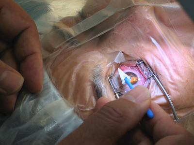 Cataract surgery is, according to Alcon, the most common ophthalmic surgery performed around the world today. With an ageing global population, the number of procedures is set to increase further - suggesting a fast-growing market for the femtosecond laser procedures pioneered by LenSx. Credit: iStockphoto