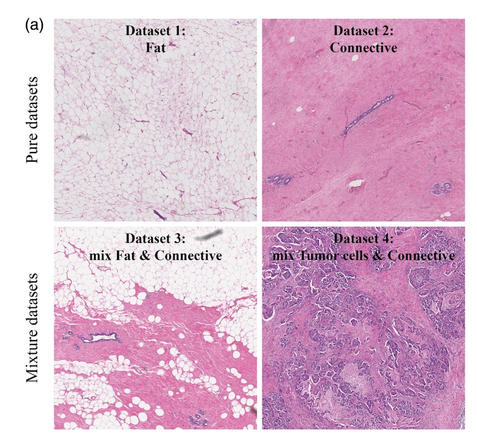 Examples of histopathology in the datasets used in the analyses, with differing combinations of cnnective tissue, fat, and tumor cells. Credit: Netherlands Cancer Institute/JBO.