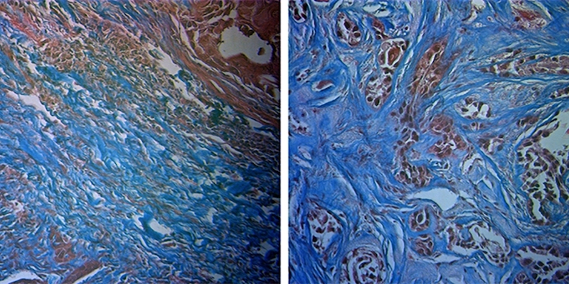Histological staining of a radiation-sensitive (left) and radiation-resistant tumor (right) showed differing amounts of collagen (blue), a difference that Raman spectroscopy can detect. Credit: University of Arkansas.