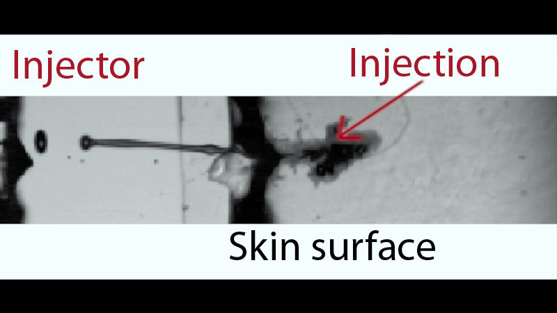 How the laser pulse-driven injectant passes through the skin into a patient's tissue. Image: University of Twente.
