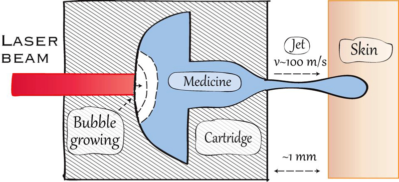 Working principle of needle-free injection: laser heating the fluid. The growing bubble pushes out the fluid (medicine or ink) at very high speed.