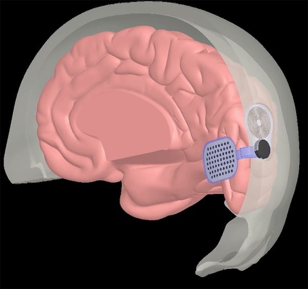 By-passing both the eye and the optic nerve, the Orion implant from Second Sight is placed directly onto the visual cortex of the patient's brain. Signals received from a miniature camera integrated within a pair of glasses are interpreted as 
