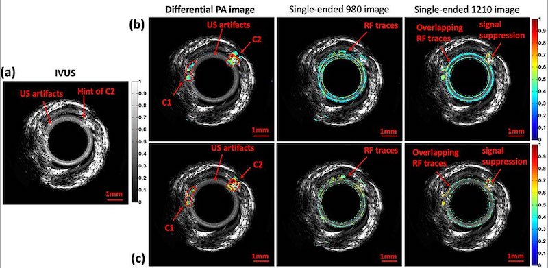 Ultrasound and photoacoustic radar images of an artery phantom reveal the cholesterol plaque inside. Credit: University of Toronto.
