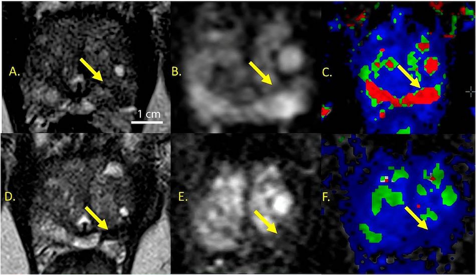 Gold nanoparticles allowed precise thermal ablation of prostate tumors. Credit: Nanospectra Biosciences.