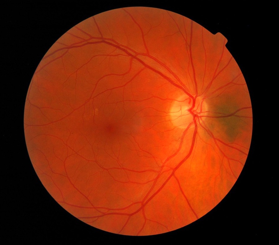 Retinal prostheses could help restore vision to patients suffering with retinitis pigmentosa and age-related macular degeneration. Credit: stock photo.