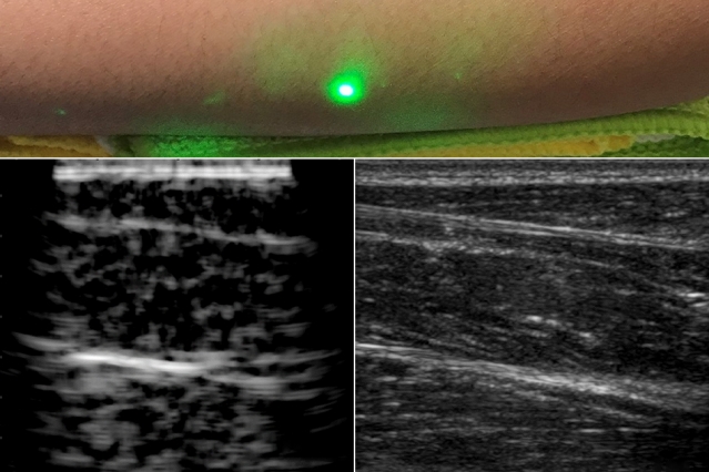 A new ultrasound technique uses lasers to produce images beneath the skin, without making contact with the skin as conventional ultrasound probes do. The new laser ultrasound technique was used to produce an image (left) of a human forearm (above), which was also imaged using conventional ultrasound (right). Image courtesy of the researchers.