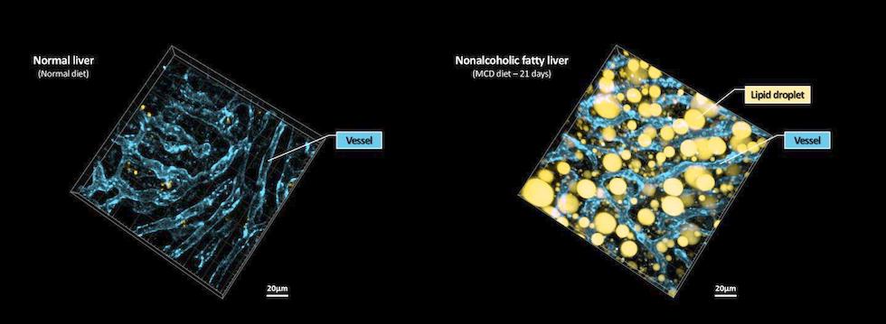 Intravital imaging captured 3D images of lipid droplet accumulation (yellow) and microvasculature (blue) in the livers of normal mice and mice with induced NAFLD. Credit: Pilhan Kim/KAIST.
