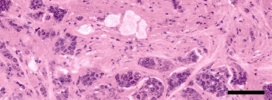 High-resolution virtual histology images allow detailed visualization of tissue without time-consuming staining procedures. Shown is a virtual histology image of sectioned breast lumpectomy sample. Scale bar: 50 microns.
Credit: Nathaniel J. M. Haven, University of Alberta.