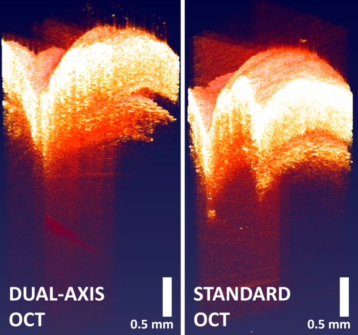 A needle point more than one millimeter beneath a mouse's skin can be seen toward the bottom of the dual-axis image (left) but not in the standard image (right). The signal of the needle in both has been adjusted for better visualization of the needle. Credit Evan Jelly/Duke University.