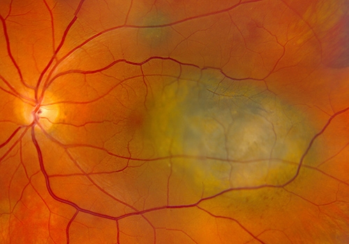A retinal image showing malignant choroidal melanoma. This form of cancer is found in a layer under the retina called the choroid. Although rare, with only about 6-7 out of every million people in North America diagnosed with the condition each year, it is also the most common malignancy found in the eye. Current treatment options are limited, with larger tumors typically requiring removal of the affected eye. Aura Biosciences