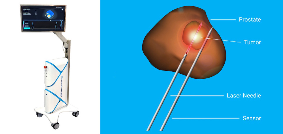A laser needle and sensor are inserted into the target tissue under ultrasound guidance. The laser needle gently heats tissue causing coagulation necrosis. Requiring only local anesthesia, patients experience minimal to no downtime. Text and pic credit: Avenda Health.
