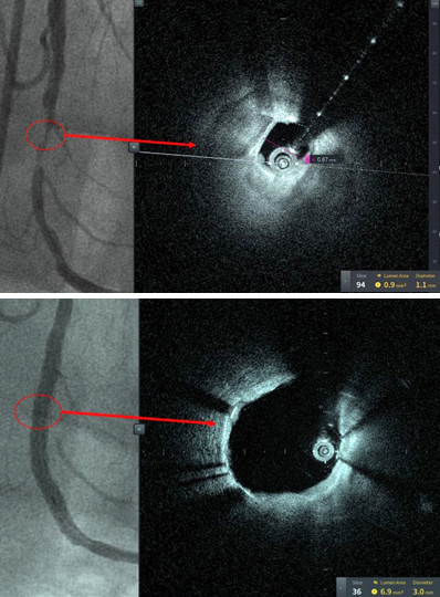 These images are from the first patient treated with HF-OCT, performed at Tampa General Hospital, a 1007-bed academic medical center and the primary teaching hospital for the USF Health Morsani College of Medicine. Figure 1A reveals the 90% stenosis pre-intervention. Despite this high-grade stenosis, HF-OCT was able to obtain excellent image quality. Figure 1B is after coronary stenting, confirming successful stent expansion. Credit: PRNewsfoto / Tampa General Hospital.