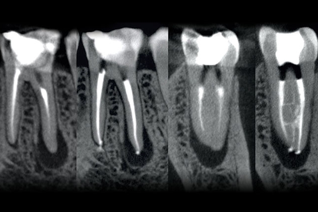 Biolase and its partner EdgeEndo have just received FDA marketing clearance for their co-developed 