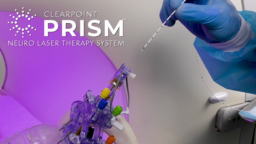ClearPoint Prism is used to necrotize or coagulate soft tissue through interstitial irradiation or thermal therapy. Credit: ClearPoint Neuro.