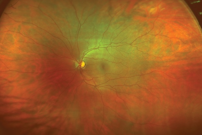 A healthy human retina, as imaged using equipment from Optos. PulseMedica says that it is developing a system capable of high-accuracy, real-time 3D mapping, that can potentially be used as the basis for treating several retinal diseases with a femtosecond laser - as well as so-called 
