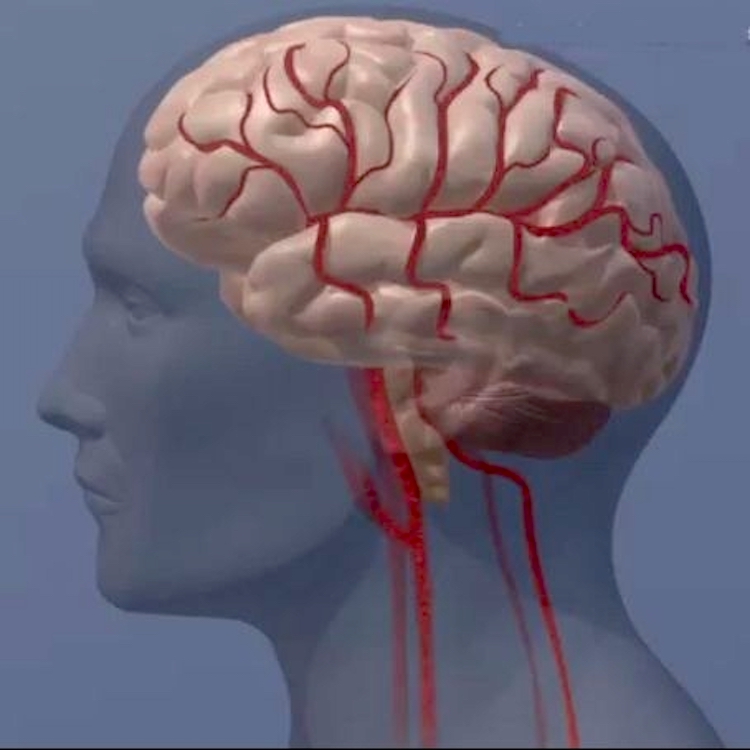 Blocked arteries can restrict blood flow to the brain. Credit: American Heart Association.