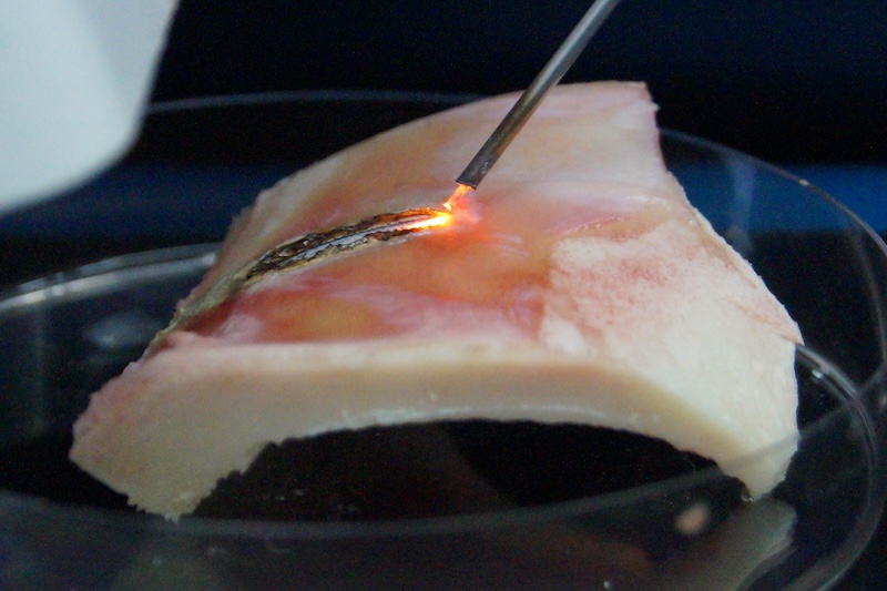 The laser can precisely regulate bone removal, helping achieve a precise passage to the nerve canal. Credit: LZH.