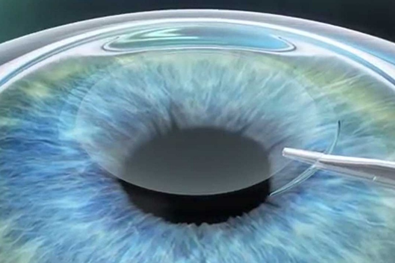 Femtosecond laser-assisted cataract surgery (FLACS) has become widespread in the US since its introduction just over a decade ago. Image: Boulder Medical Center.