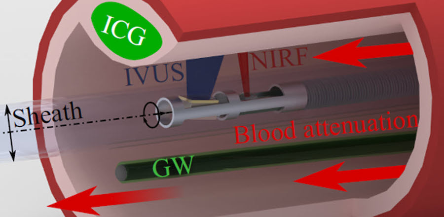 The variable fluorescence attenuation of blood has been a hindrance to near-infrared fluorescence (NIRF) measurements in cardiovascular imaging. Researchers have devised an innovative correction method in which the guidewire (GW) is coated with the fluorescent agent (ICG) and used as a reference standard in each frame, leading to a much higher accuracy. Credit: TUM.