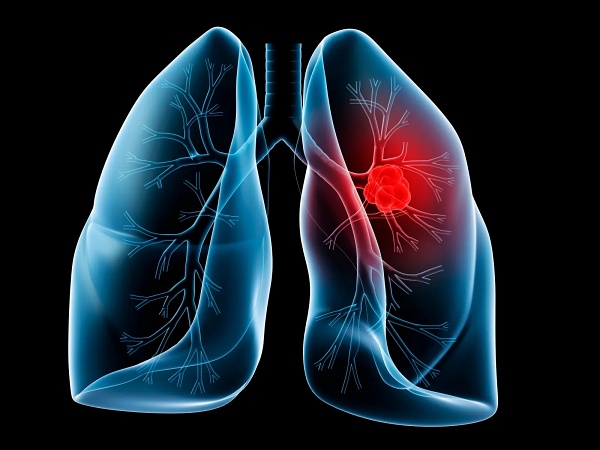 According to World Cancer Research Fund International, lung cancer is the second most common cancer worldwide - and the most common in men. According to WHO figures it is the most common cause of cancer deaths globally, responsible for 1.8 million deaths in 2020. Image: Mayo Clinic.