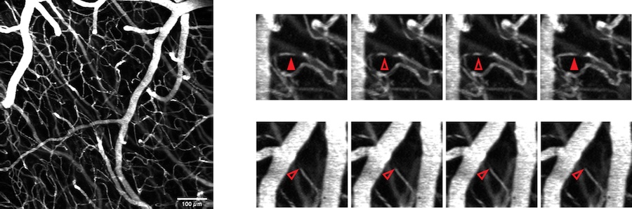 Bessel beam two-photon microscopy can be used to visualize capillaries in the brain. (Left) Maximum intensity projection to observe capillary stalling. (Right) Representative examples of different types of stalling events. Credit: Boston University.