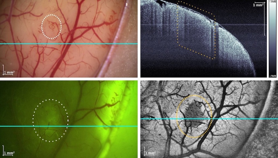 Top left shows white light camera view indicating visible vascularization, and the same region shows increased fluorescence indicative of tumor (bottom left). Conventional OCT B-scan (top right) shows less detail than MGz-OCT en-face (bottom right) that clearly shows the tumor. Credit: UniversitÃ¤t zu LÃ¼beck, Medizinisches Laserzentrum LÃ¼beck GmbH & UniversitÃ¤tsklinikum Schleswig-Holstein