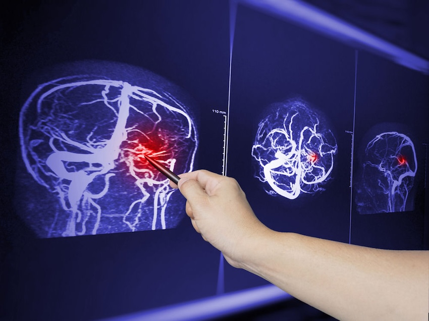 A new system can automatically monitor multiple brain health biomarkers simultaneously, which could help prevent additional complications after a traumatic brain injury. Credit: April stock/Shutterstock via Imperial.