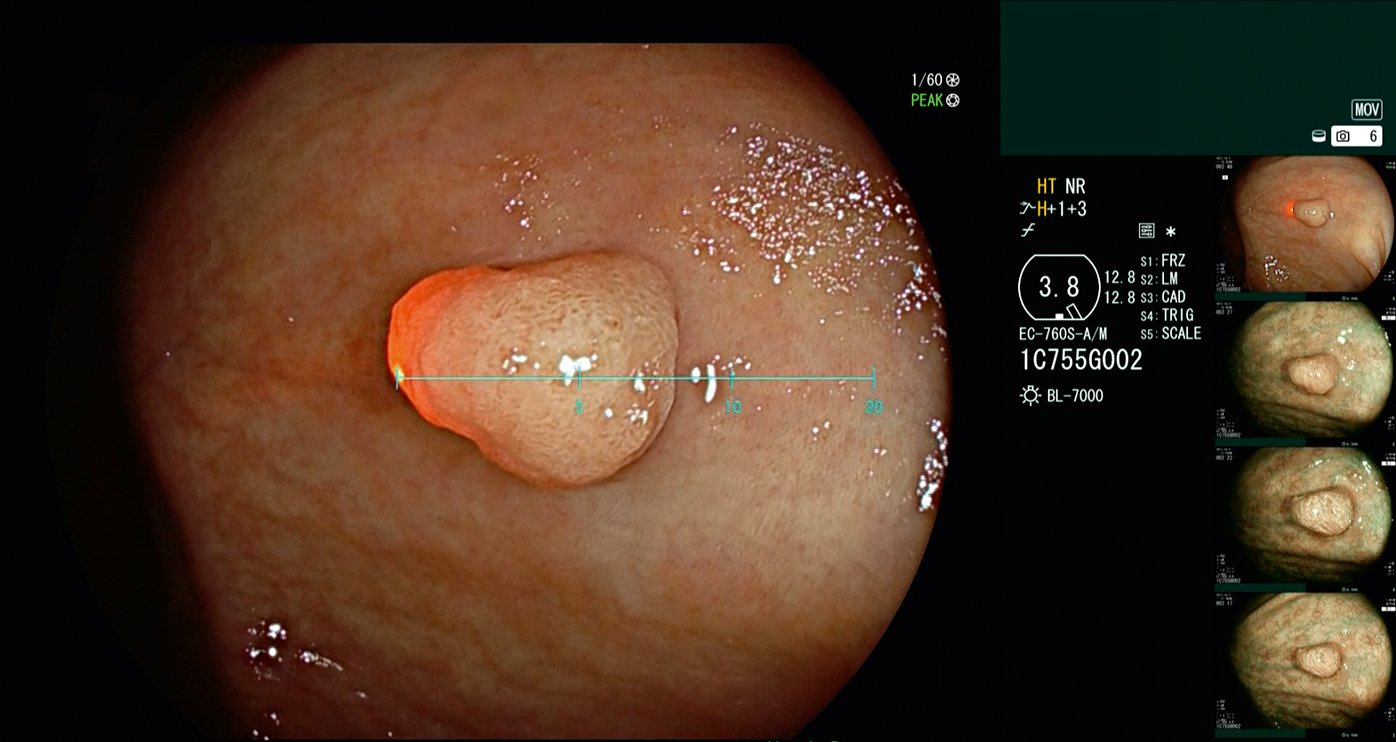 SCALE EYE presents endoscopists with a reliable objective way to assess the dimensions of colonic lesions. Credit: Fujifilm Healthcare.