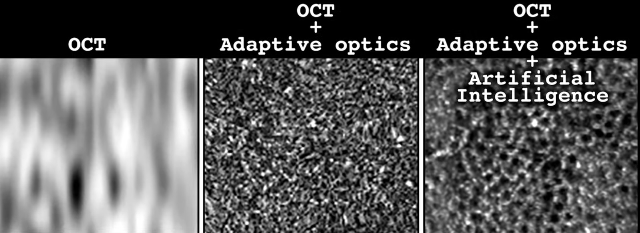 (A) A top-down view of the RPE layer as seen by clinical OCT. Although the image is zoomed in to the scale of single cells, it is difficult to visualize the cells. (B) AO-OCT provides a more detailed image of the RPE layer, but the cells are obscured by speckle. (C) There is a remarkable improvement in RPE cell visualization gained by applying AI to the speckled AO-OCT image. Each dark area represents a single RPE cell. Credit: Vineeta Das/NEI. (Front page image: RPE cells as seen with high-resolution microscopy. Credit: Kapil Bharti/NEI.) 
