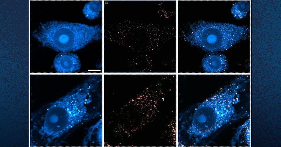 These images show microglia containing lipid droplets (white spots). Researchers at UC San Diego have revealed that in brains with Alzheimer's and related diseases, neurons offload excess lipid droplets to microglia, which triggers further inflammation. Credit: UC San Diego Health Sciences.
