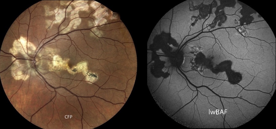 An eye affected by the rare serpiginous chorioretinopathy. The name comes from the snake-like spread of the disease across the retina. The ocular fundus photograph (left) shows areas of scarring in a light yellow tone. Active inflammatory lesions usually appear as light-colored areas on fundus autofluorescence (right). Credit: University Hospital Bonn.