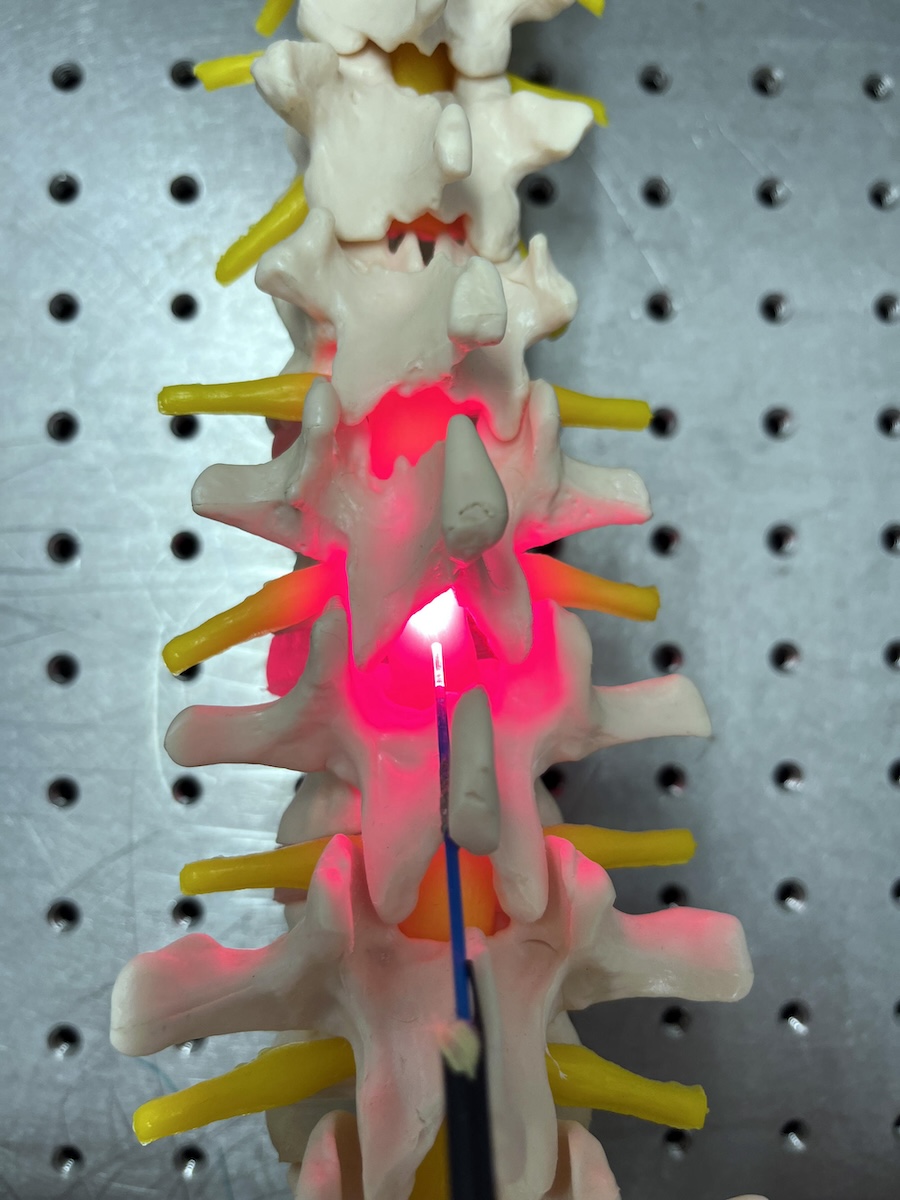Surgery after spinal cord injury is common. The concept could offer surgeons the opportunity during the same operation to implant a device which could help protect and repair the spinal cord itself. Credit: University of Birmingham.