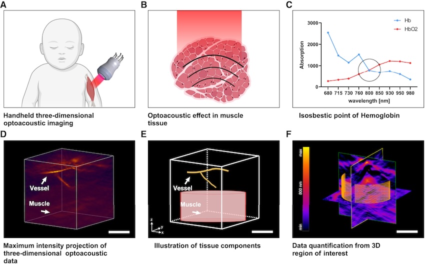 Illustration of handheld three-dimensional optoacoustic muscle imaging in pediatric patients, leading to (F) three-dimensional OAI data at 800 nm, with cylindrical region of interest shown in orange. Scale bars represent 5 mm. Credit: FAU/Med journal.