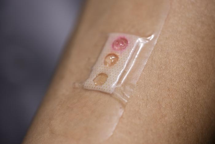 The plaster developed by NTU Singapore researchers comprises microlaser sensors embedded in liquid crystal droplets. The sensors are customised to pick up three different types of biomarkers (lactate, glucose, urea). A different coloured liquid crystal dot on the plaster distinguishes each biomarker. Credit: NTU Singapore