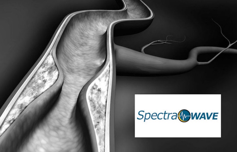 Using a combination of OCT and NIRS techniques for intravascular imaging yields both structural and molecular information about arterial plaques, with SpectraWAVE claiming better clinical outcomes for patients undergoing stent placement interventions. Image: SpectraWAVE.