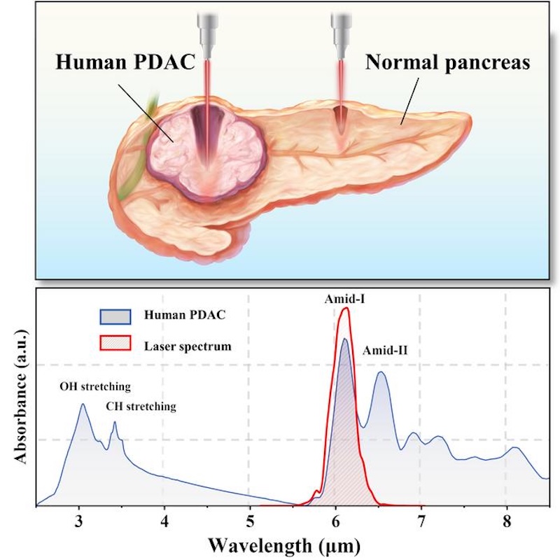 Using a laser wavelength that matches the collagen absorption peak allowed researchers to selectively ablate pancreatic ductal adenocarcinoma (PDAC) without harming healthy tissue. Credit: Houkun Liang, Sichuan University.