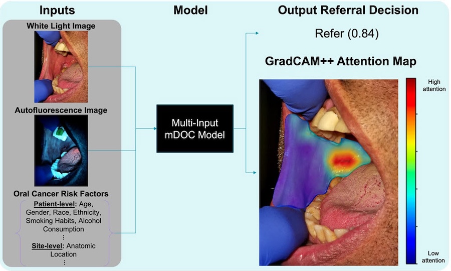 Analysis of an anatomic site using the mobile Detection of Oral Cancer (mDOC) model involves multiple inputs: images of clinically relevant regions are masked, cropped, resized for analysis, and passed through the mDOC system, along with oral cancer risk factors. The output referral decision is 