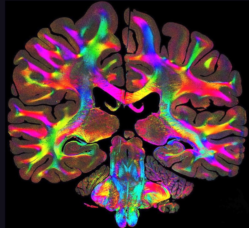 Computational scattered light imaging shows the orientation and organization of tissue fibers at micrometer resolution. The colors represent different fiber orientations. Credit: Marios Georgiadis/Stanford University.