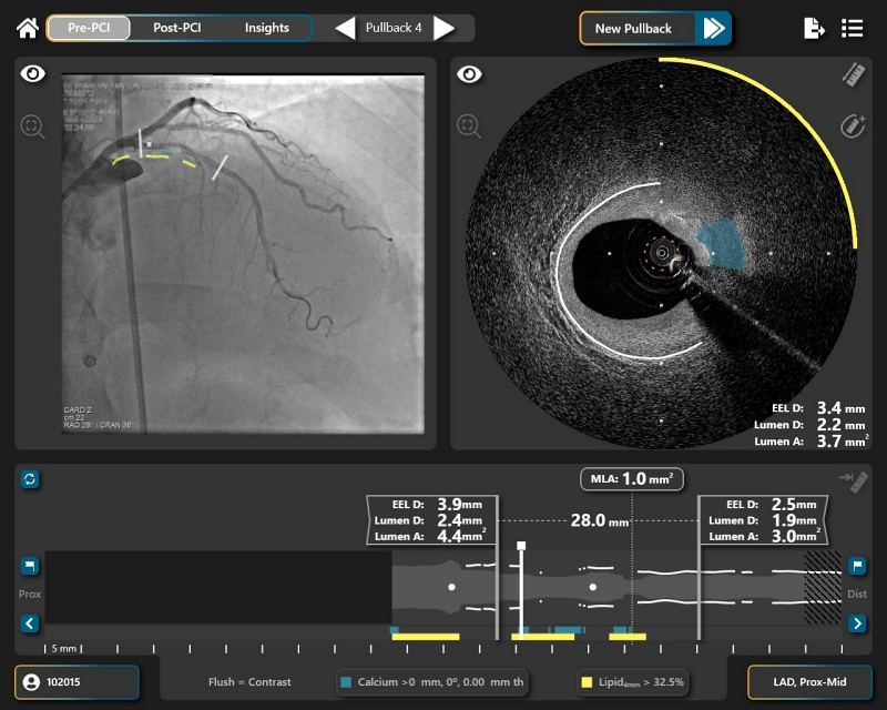 The SpectraWAVE acquisition will expand Philips' existing intravascular imaging and physiological assessment device portfolio, with a dual optical imaging technique combining OCT and NIRS to investigate both the shape and biochemical nature of arterial plaques - providing an extra level of insight and, it is hoped, improved patient outcomes. Image: SpectraWAVE.