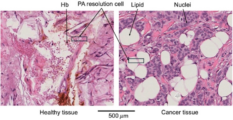 Zoomed-in stained images of healthy and cancer tissues, with arrows pointing to chromophore features of interest and boxes that denote the relative size of a photoacoustic image resolution cell. Credit: PULSE/Biomedical Optics Express.